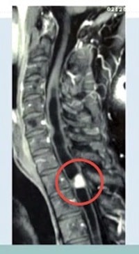 McCormick’s Video: ‘Textbook’ Removal of Spinal Cord Tumor