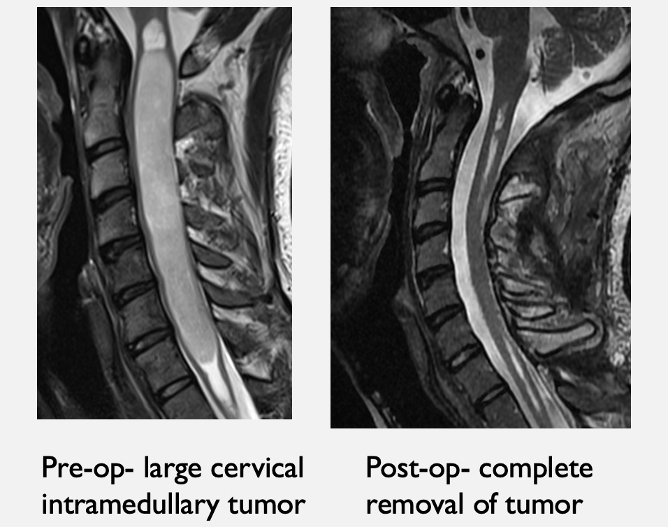 Dr. McCormick presents at Neuroscience Grand Rounds on Spinal Tumors at