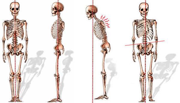 Adult-Spinal-Deformities