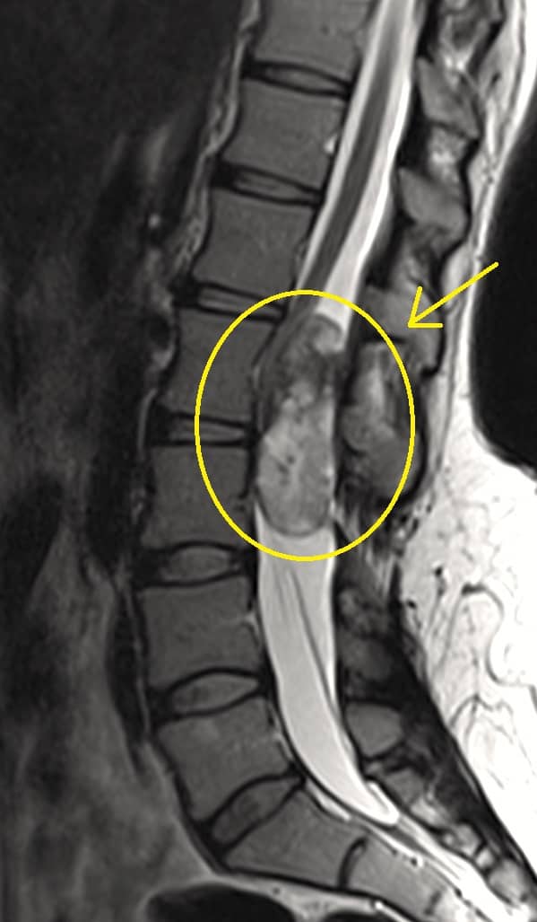 MRI of lumbar spine shows large dermoid tumor in the spinal canal putting severe pressure on the spinal cord and nerve roots.