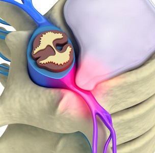 Prolapse of intervertebral disc closeup 3d image. (c) alexmit/Big Stock