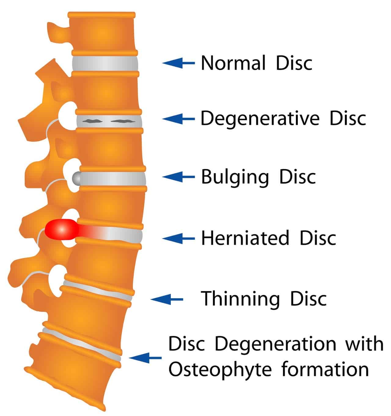 Bulging Disc