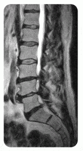 MRI of Lumbar Spinal Stenosis Multiple level disc bulging and spinal canal narrowing has obstructed the flow of the clear white spinal fluid within the lower canal.